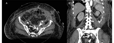 Initial Ct Angiogram Of The Left Internal Iliac Artery Mycotic