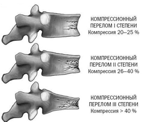 Компрессионный перелом позвоночника поясничного отдела: лечение ...