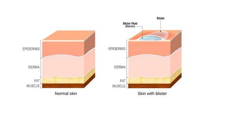 Diagram Friction Blister Diagram Mydiagramonline