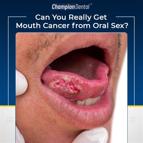 How Oral Sex Can Cause Cancer Champion Dental