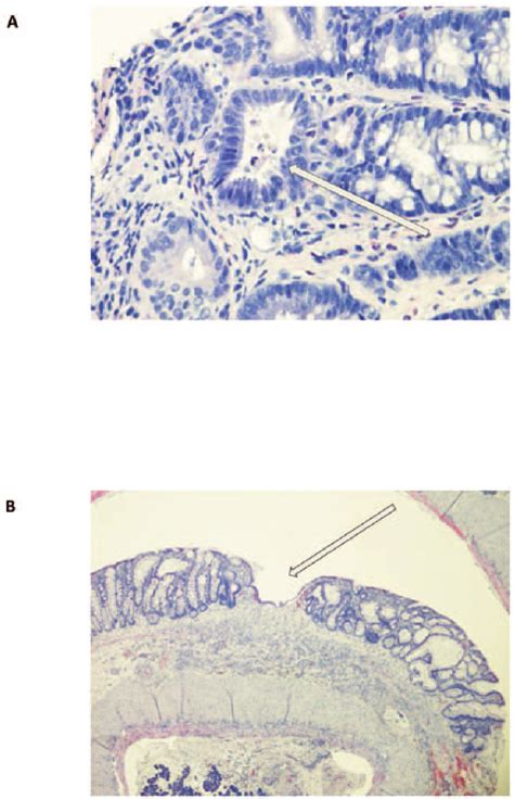 Histologic Appearance Of An Endoscopic Biopsy And Whole Colon Specimen Download Scientific