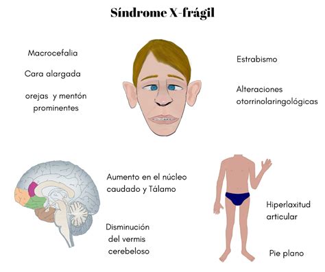 Síndrome X Frágil Autismo Ciudad De México