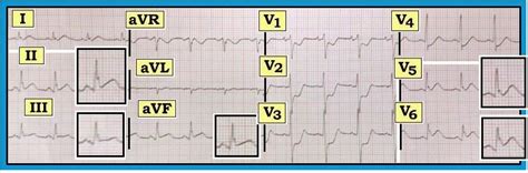 ECG Interpretation ECG Interpretation Review 80 Acute STEMI RCA Vs