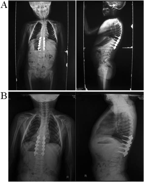 Postoperative Anteroposterior And Lateral Radiographs A Download Scientific Diagram