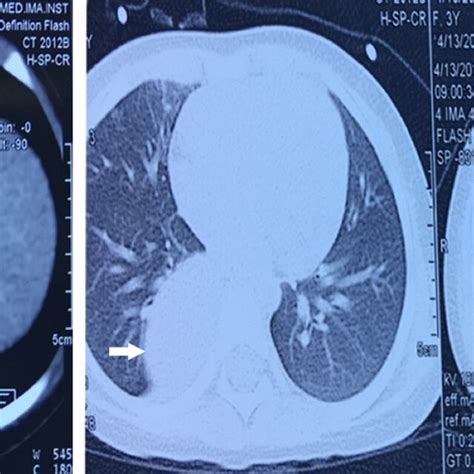 Conventional CT scan of pulmonary sequestration (lesion was marked by ...