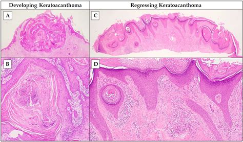 Keratoacanthoma versus Squamous-Cell Carcinoma: Histopathological