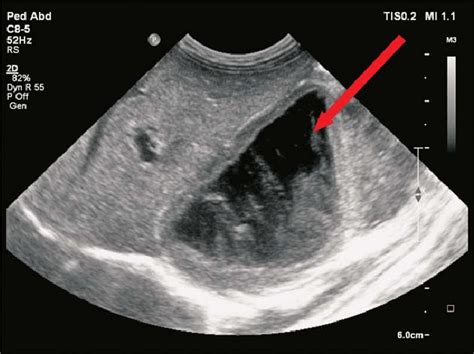 Muscle Hematoma Ultrasound