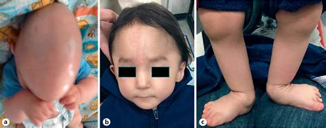 Figure 1 From Jacobsen Syndrome Surgical Complications Due To