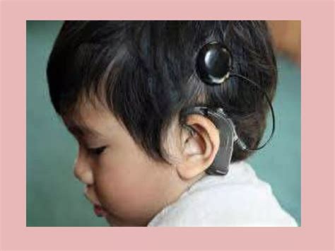 Cochlear Implant Autosaved Pptx