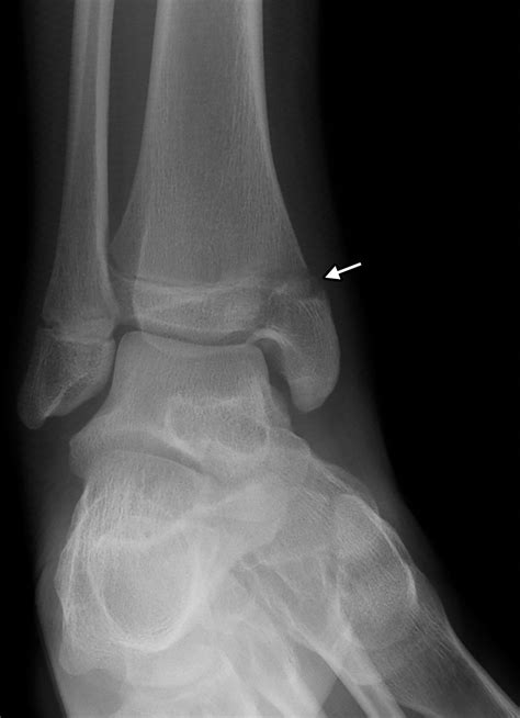 Acute Fractures And Dislocations Of The Ankle And Foot In Children