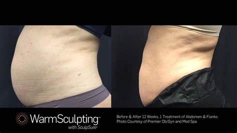 Sonabello procedures offer fast body sculpting results now 17