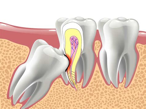 Impacted Wisdom Teeth Signs And Symptoms To Look Out For St Louis