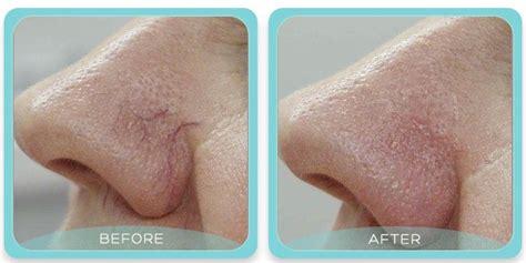 Red Thread Vein Removal Skin Clinic Brighton Hove