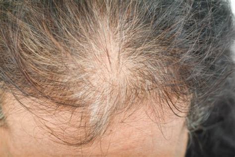 What is Scarring Alopecia? - Advance Techniques Hair Replacement ...