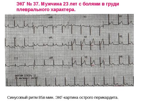 Расшифровка диагноза экг