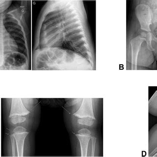 A Probands Chest X Ray At 18 Months Old Revealing Widening And