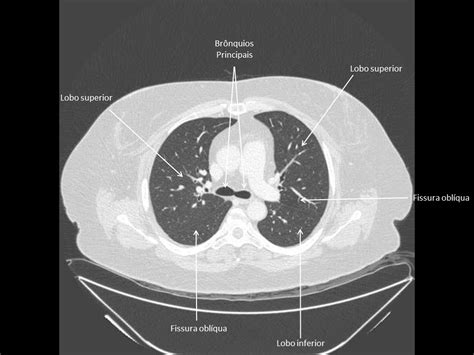 Anatomia Tc De TÓrax