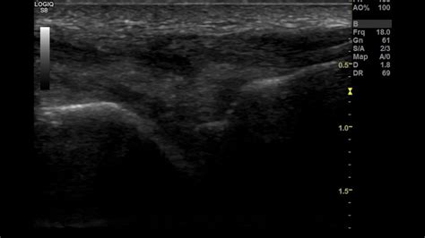 Arthrocentesis of the Wrist Joint - Internet Book Of MSK Ultrasound