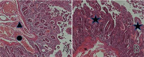 Hematoxylin And Eosin Staining Of Ischemic Intestinal Mucosa Original