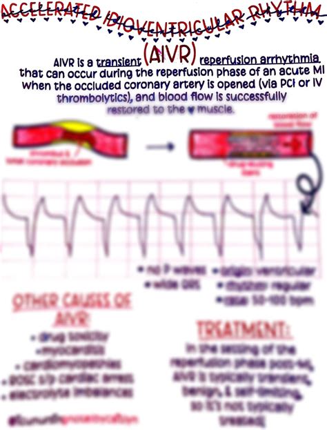 Accelerated Idioventricular Rhythm AIVR - Etsy