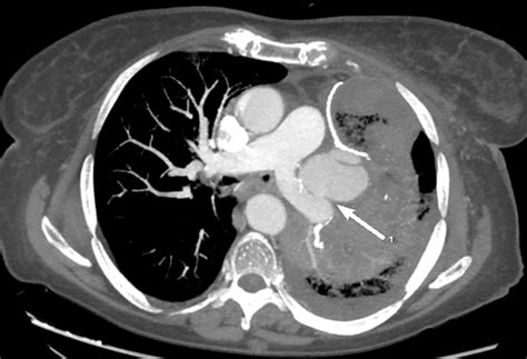 Axial Chest Computed Tomography Angiography Shows Pulmonary Artery Download Scientific Diagram