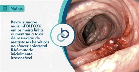 Bevacizumabe Mais Mfolfox Em Primeira Linha Aumentam A Taxa De