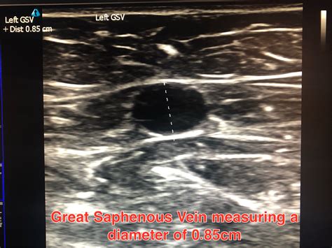 Podiatric Vein Care - Performing Diagnostic Doppler Ultrasound on the