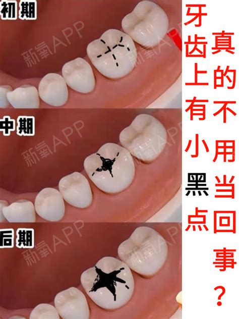 牙齿黑点 伤感说说吧