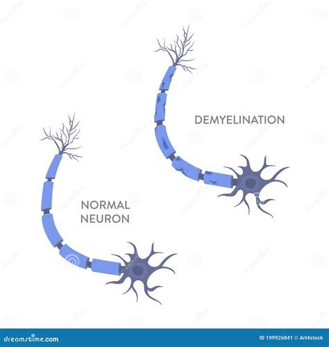 Nerve Cell Demyelination Process Medical Infographic Poster Stock