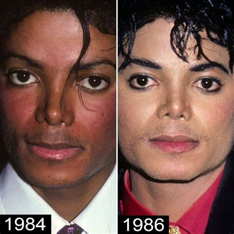 Michael Jackson Before And After Plastic Surgery And Transformation