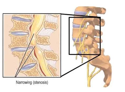 Lumbar Decompression - Bucks Spine