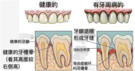 牙龈萎缩的主要原因 爱康健齿科