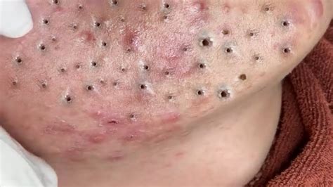 Popping Huge Blackheads And Pimple Popping Best Pimple Popping Videos