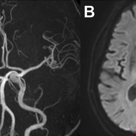 Post Procedural Imaging A Magnetic Resonance Angiography Performed