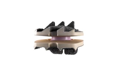 Nuvasive On Linkedin The Simplify Cervical Disc Is Anatomically