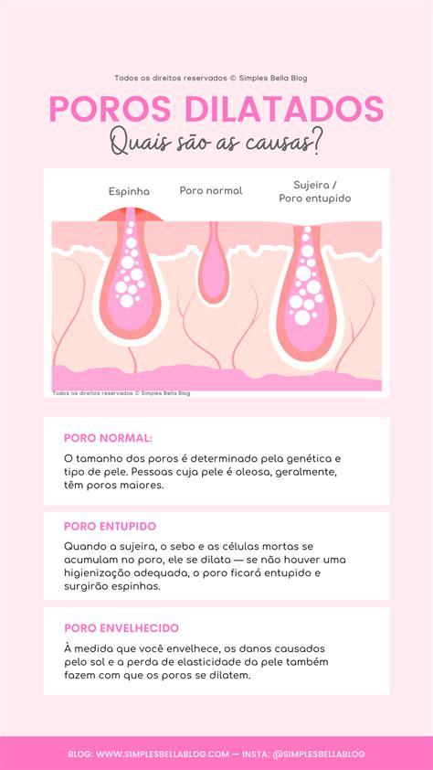 Seus poros dilatados te incomodam Veja 5 dicas para amenizá los