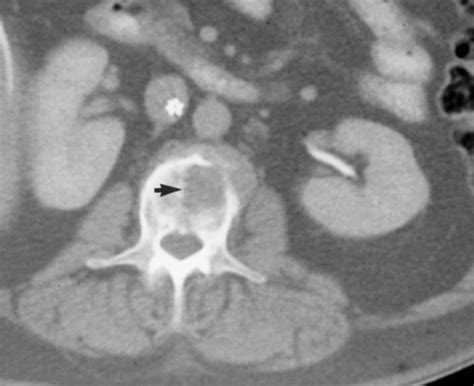 Radiofrequency Ablation Of Spinal Tumors Temperature Distribution In