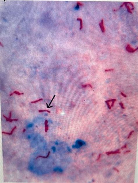 Solved The Organism Stained Red In The Acid Fast Stain Below Chegg