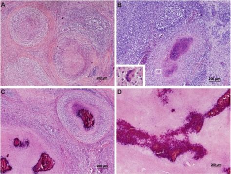 Light Micrograph Of Lymph Node Lesions Stained With He Open I