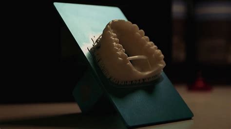 Временные виниры для зубов: подготовка и наложение. Результат после ...