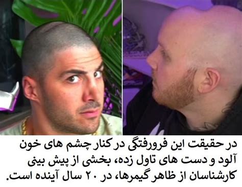 Gamers Discover Dents On Their Heads Caused By Headphones