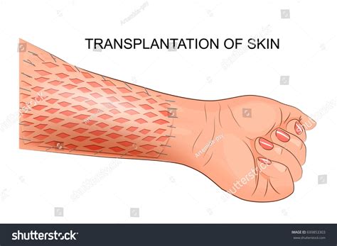 Skin Grafts Stock Illustrations Images And Vectors Shutterstock