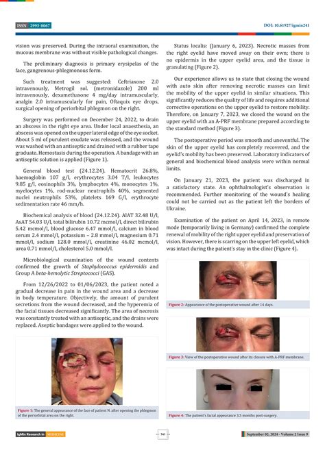 Necrotizing Facial Erysipelas: A Rare Upper Eyelid Complication | PDF