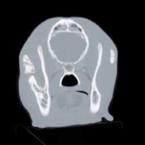 Pdf Post Traumatic Ankylosis Of The Temporomandibular Joint In The