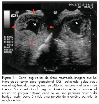 Scielo Brasil Gravidez Ect Pica Na Cicatriz Uterina De Ces Rea