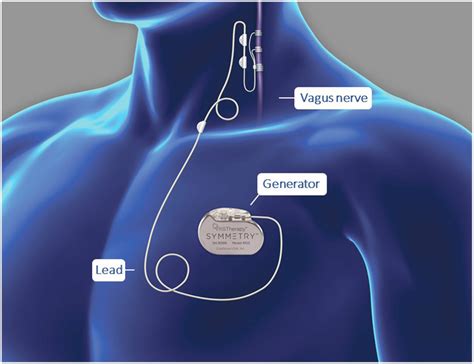 Other Forms Of Neuromodulation London Tms Centre