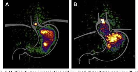 Figure 2 From Pathophysiology Of Gastroesophageal Reflux Disease Semantic Scholar