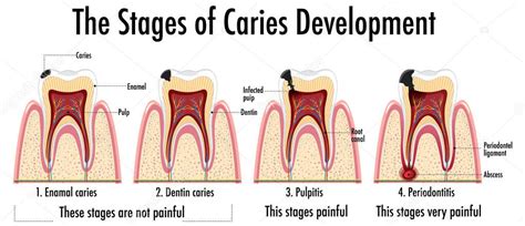 Infografía Del Ser Humano En Las Etapas De Desarrollo De La Caries