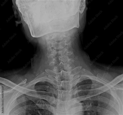 Cervical Spine Xray