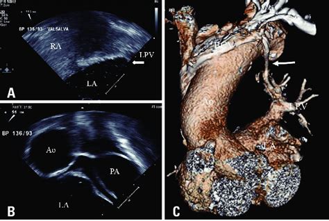 Transesophageal Echocardiography Bicaval View Of The Patient A